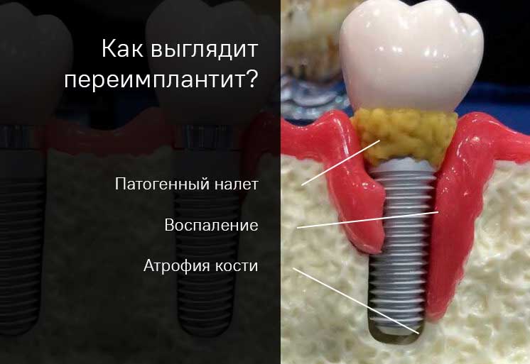 Как выглядит переимплантит