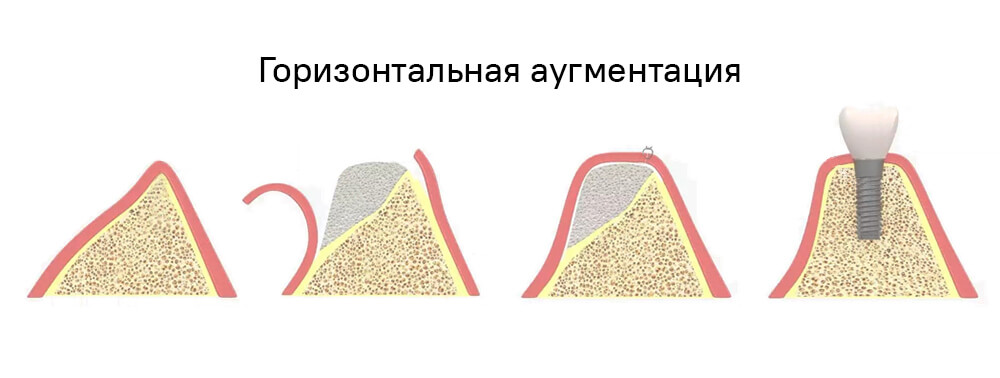 Горизонтальная аугментация