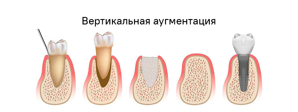 Вертикальная аугментация