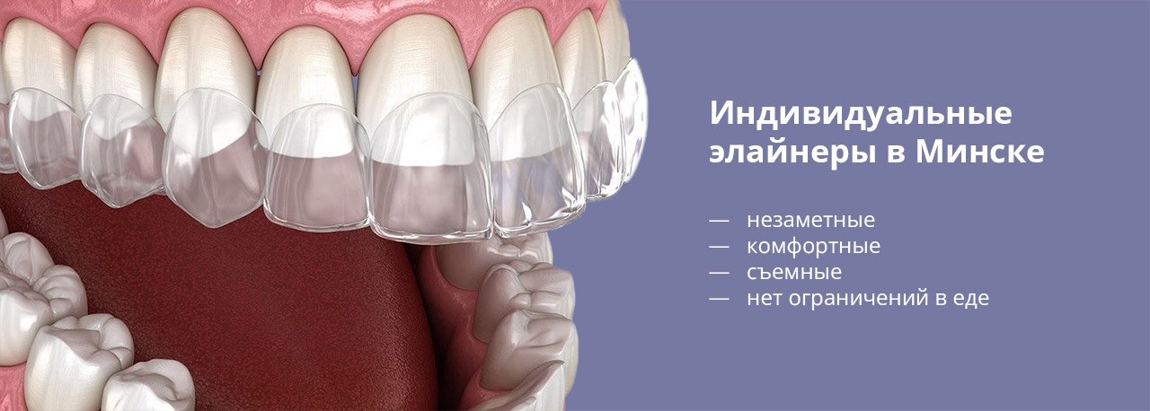 Элайнеры | Минск | Цены