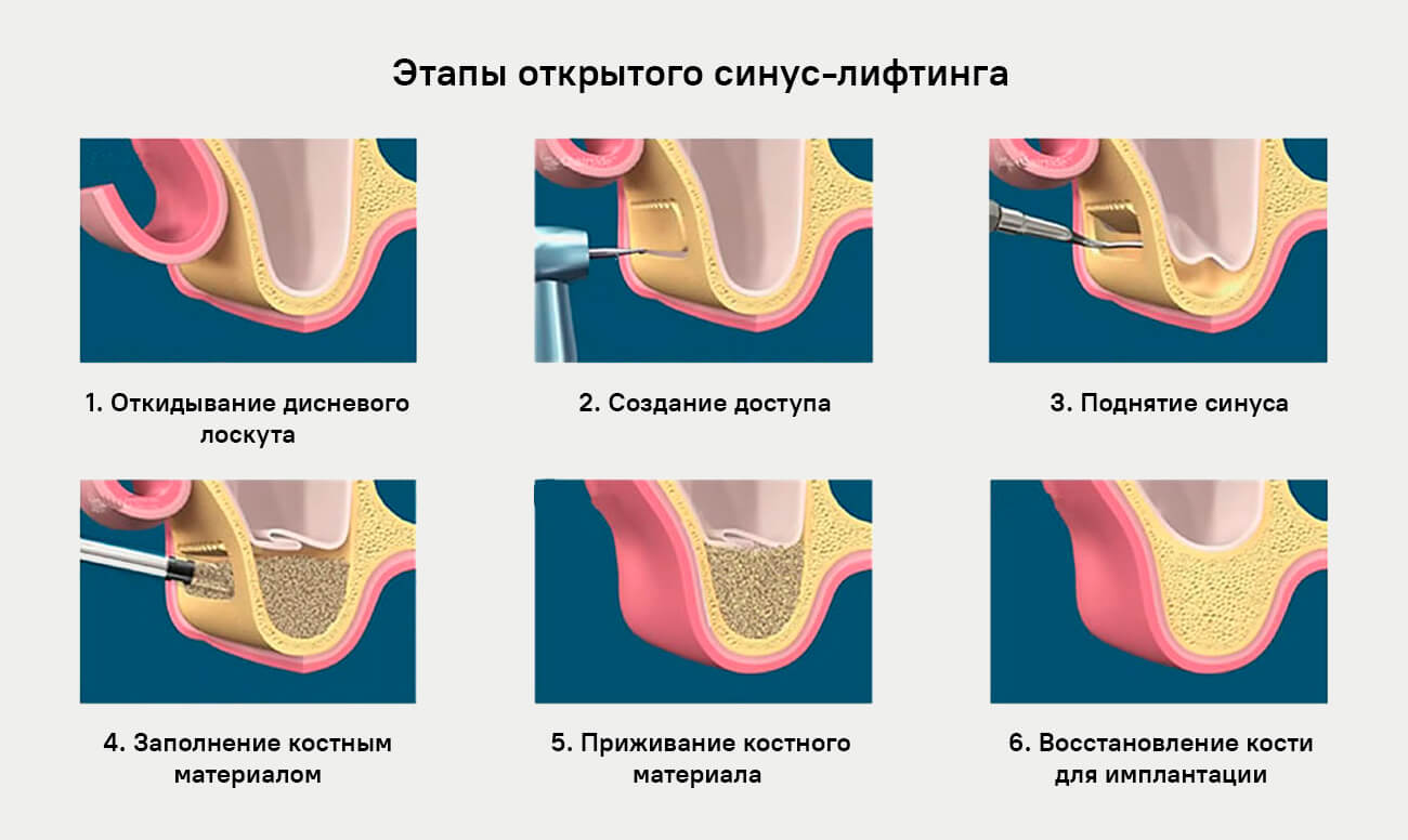 Этапы открытого синус-лифтинга