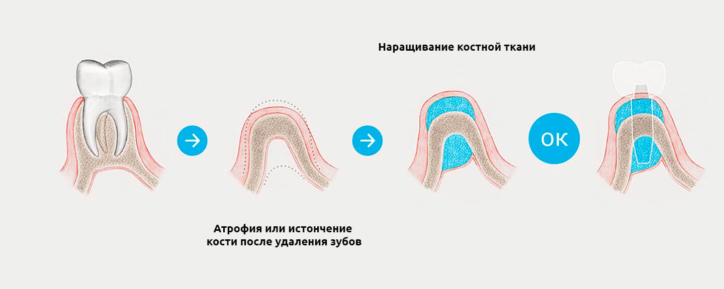 Синус-лифтинг