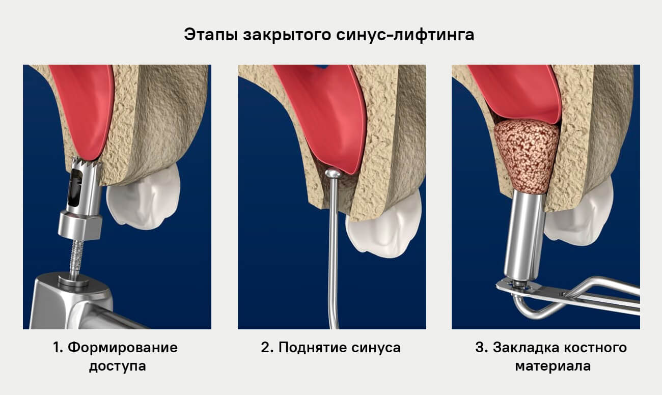 Этапы закрытого синус-лифтинга