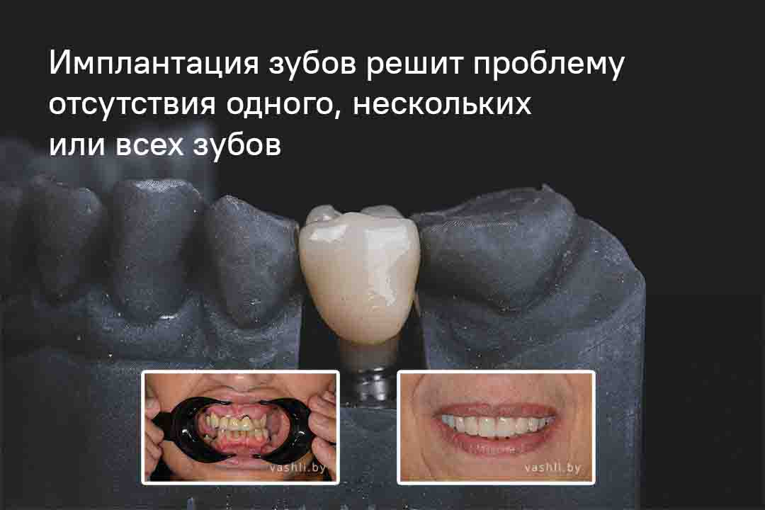 Имплантация зубов