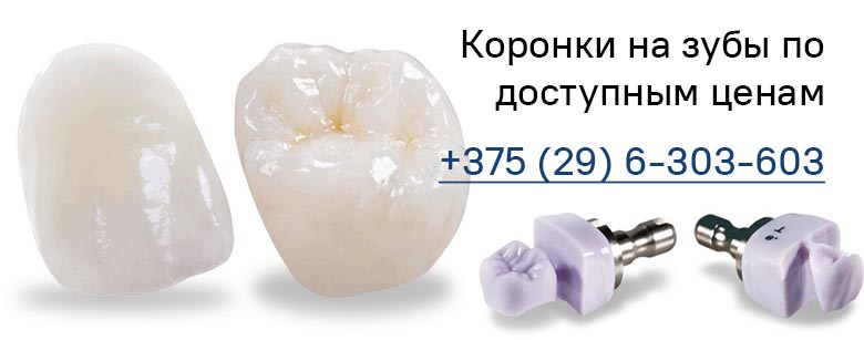 Коронки на зубы по доступным ценам в Минске