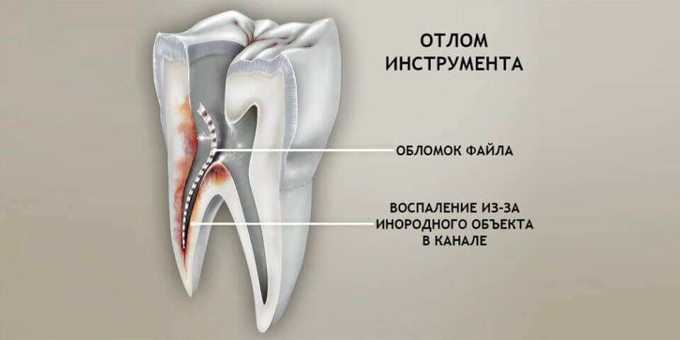 Сломанные инструменты в каналах