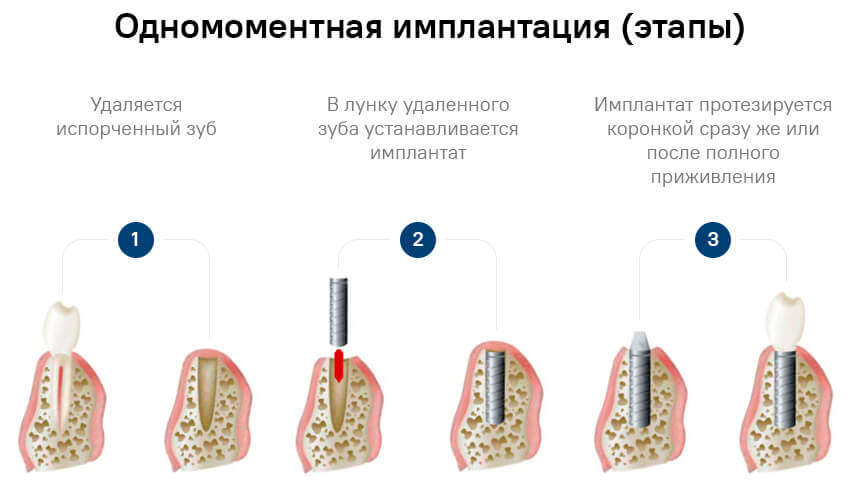 Этапы одномоментной имплантации зубов