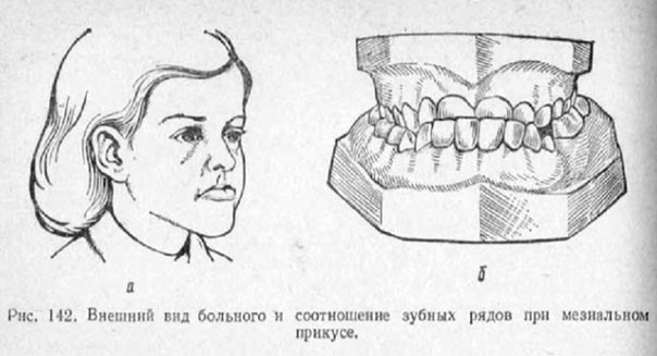 Что такое мезиальный прикус?