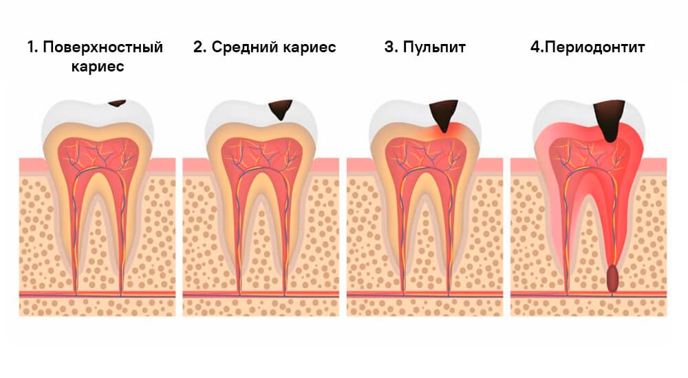 Периодонтит