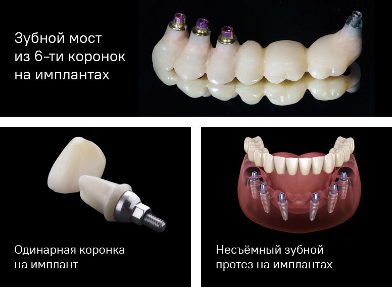 Протезирование на имплантах