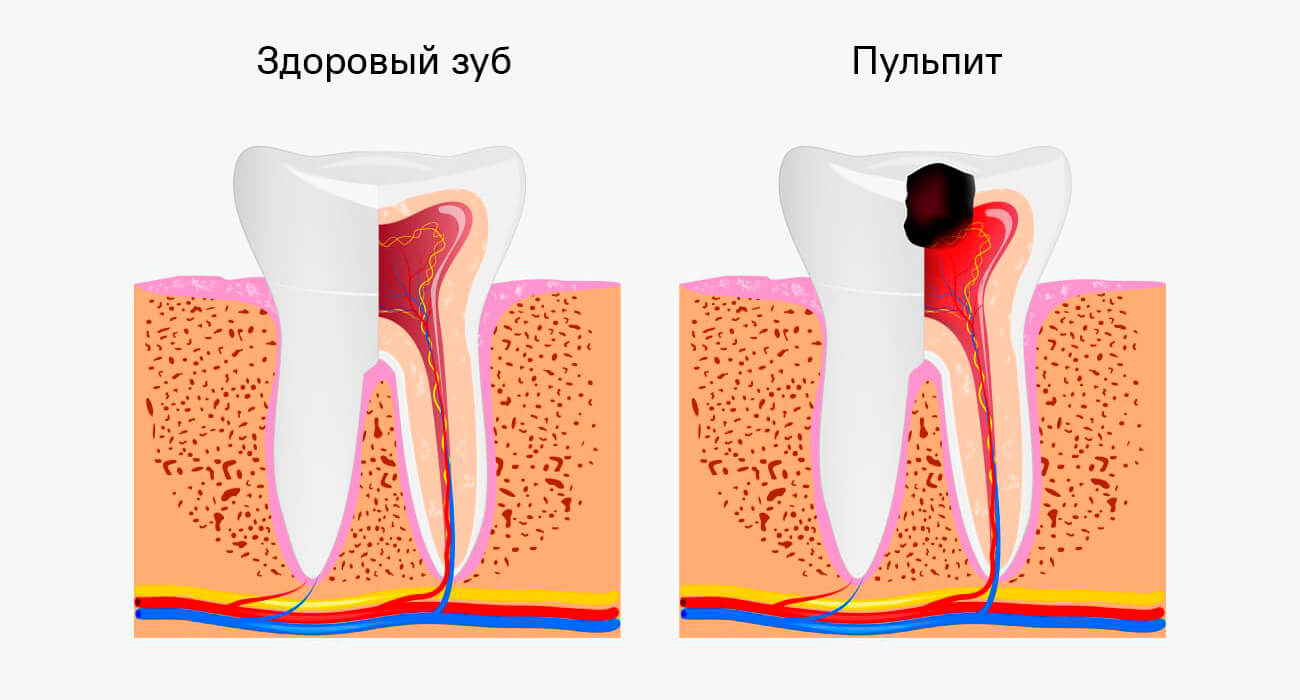 Пульпит