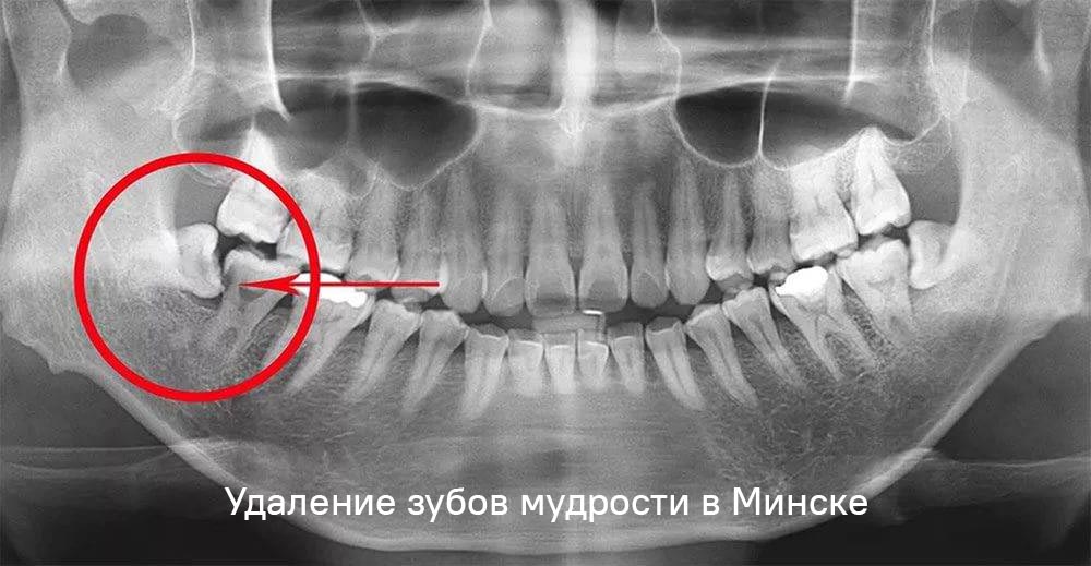 Сколько стоит удалить зуб мудрости в Минске?