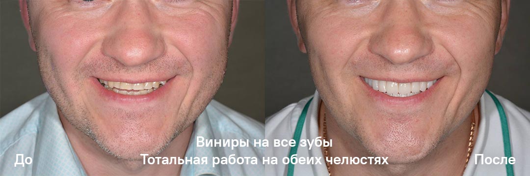 Виниры на все зубы. Тотальный виниринг в Минске
