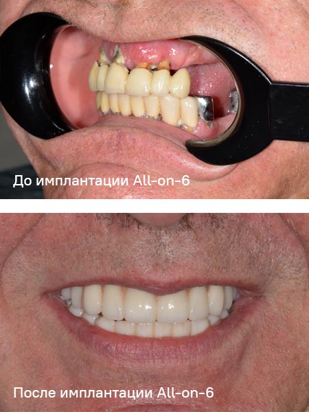 Фото работы по тотальной имплантации протоколом All-on-6